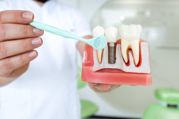 After Dental Implants