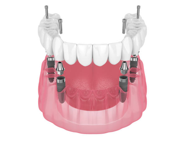 Full mouth Dental Implants paramus
