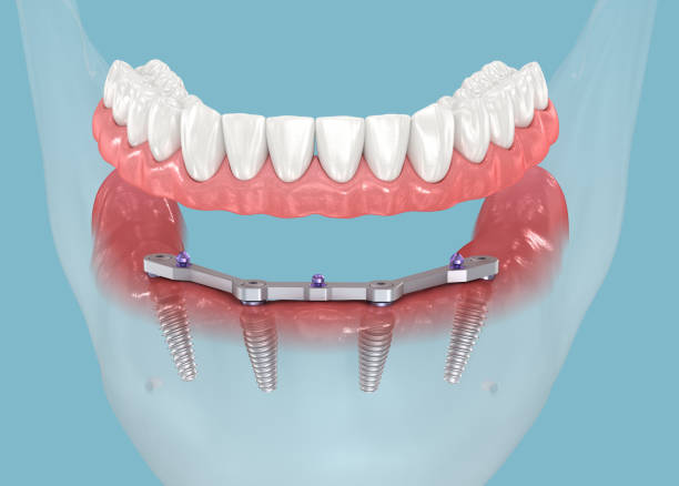 Replacing missing teeth paramus nj