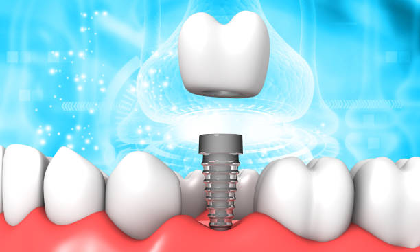 Tooth Implant vs. Root Canal