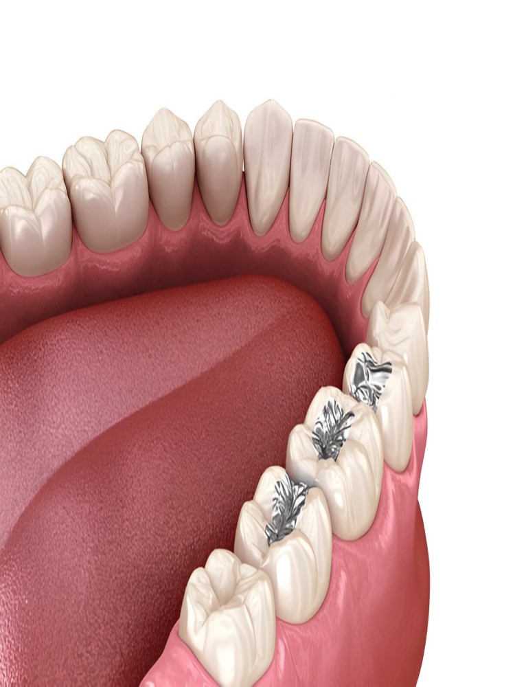 Dental Fillings in Englewood, NJ