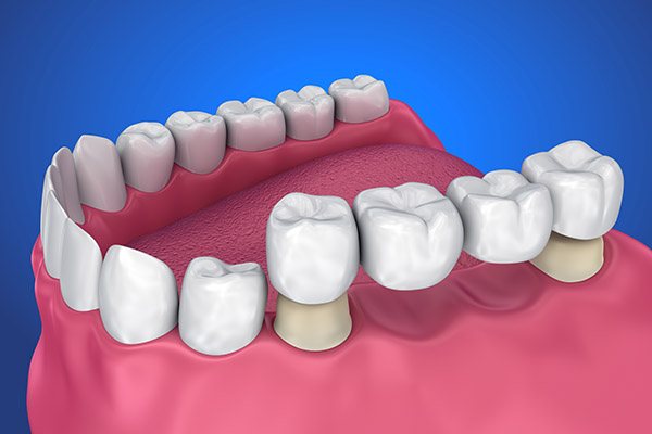 Teeth Replacement Options