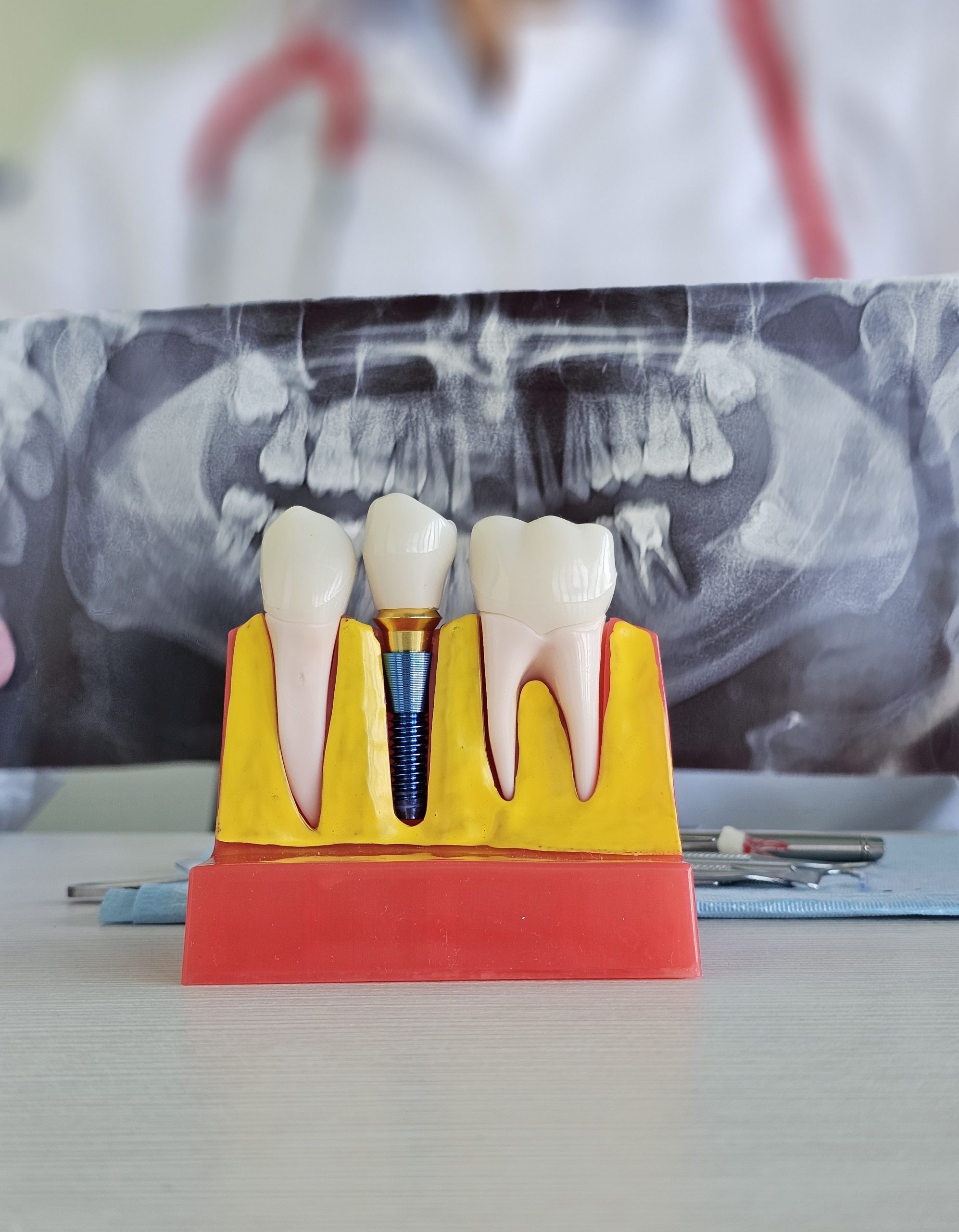Bone Grafting