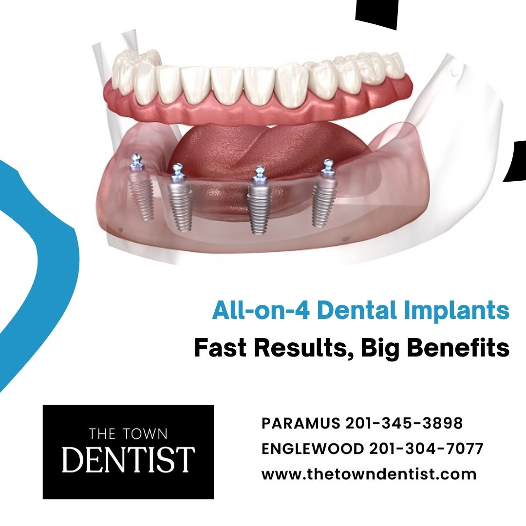 All-on-4 Dental Implants