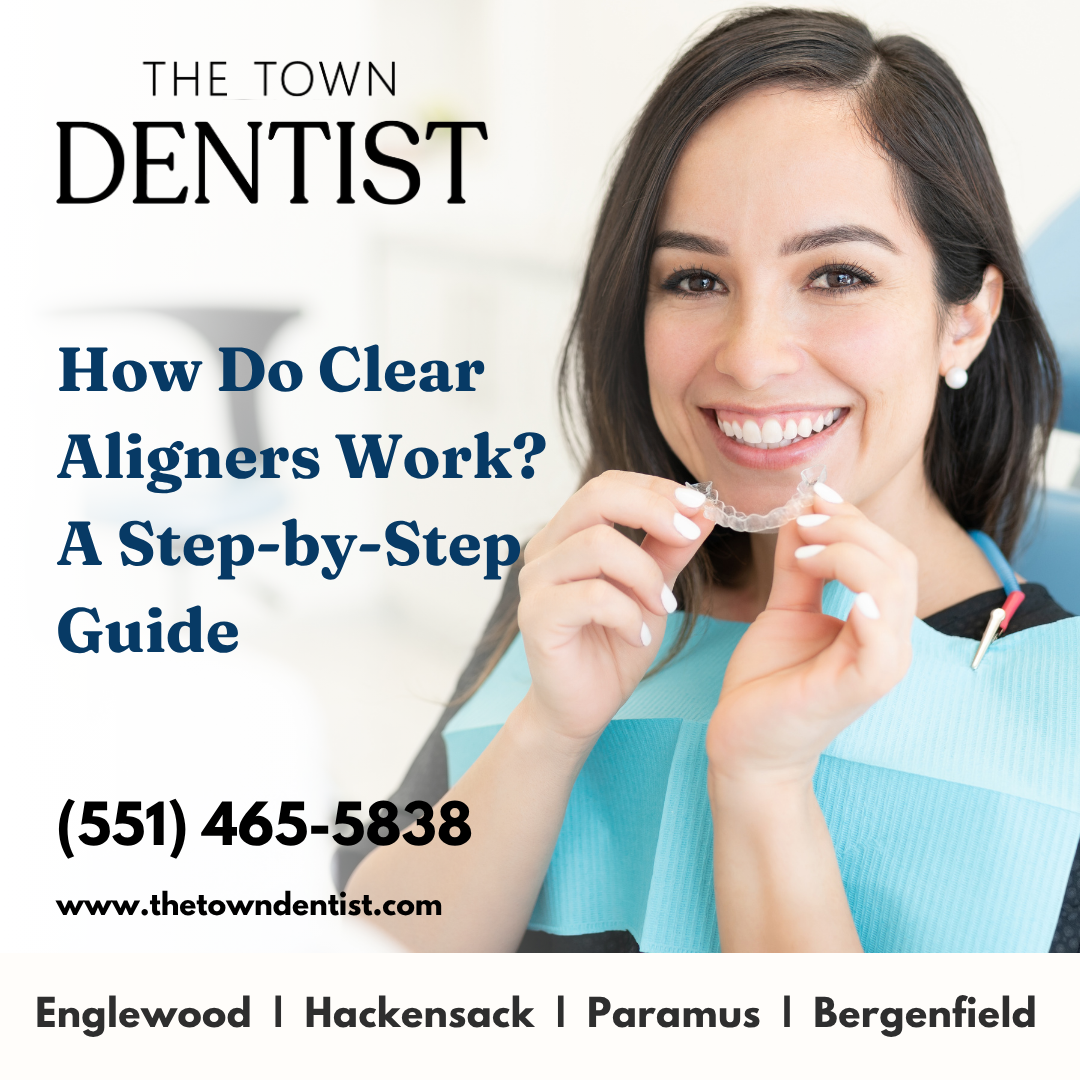 How Do Clear Aligners Work A Step-by-Step Guide
